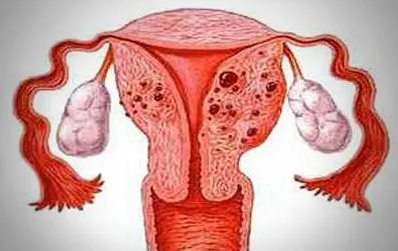 [女性健康]山西运城超声母乳分析仪器厂家科普子宫腺肌病引起痛经